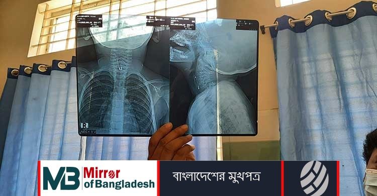 নুডুলসের সঙ্গে সেফটিপিন খেয়ে শঙ্কটাপন্ন শিশু!