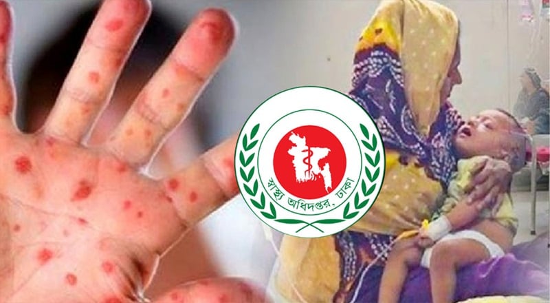 দেশে হাম ও হামের উপসর্গ নিয়ে আরও ১০ শিশুর মৃত্যু