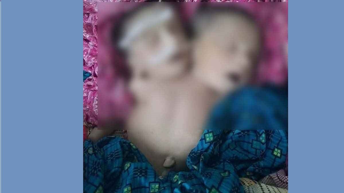দুই মাথা নিয়ে জন্ম নেওয়া শিশুটি দুই ঘণ্টা পর মারা গেল