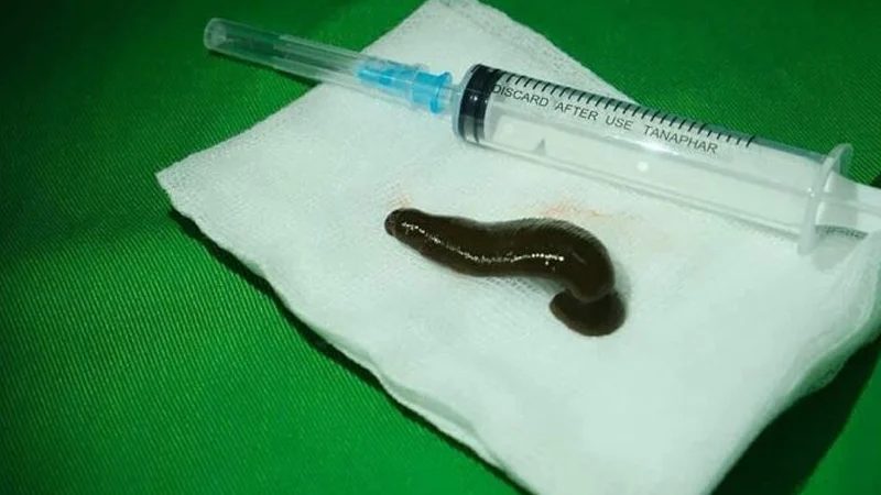 মানুষের গলা থেকে বের হলো জীবন্ত জোঁক